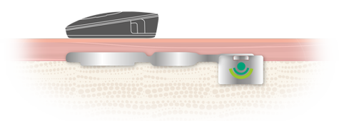 BONEBRIDGE Bone Conduction Implant